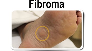 Plantar Fibromas - Friendswood, Lake Jackson, Bay City TX - Podiatrist Donald Stran