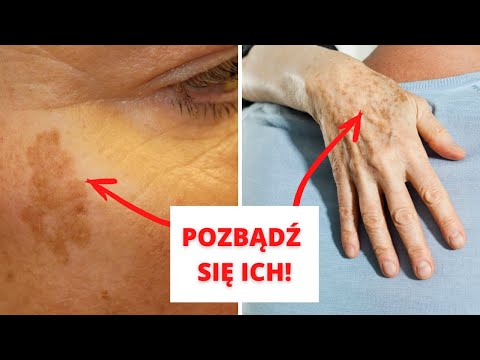 Wideo: Jak szybko pozbyć się plam starczych na twarzy