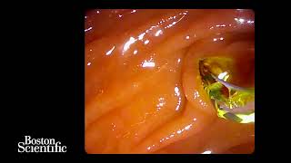 Bile duct stone removal using the Exalt single-use duodenoscope