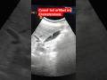 Comet tail artifact in Cholesterolosis