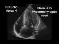 Hypertrophic Obstructive Cardiomyopathy with SAM