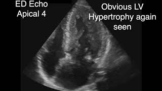 Hypertrophic Obstructive Cardiomyopathy with SAM