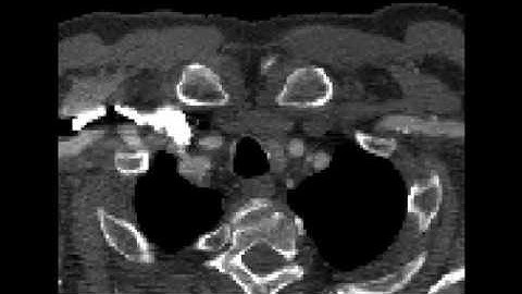 Automatic aortic segmentation from CTA using Deep Learning