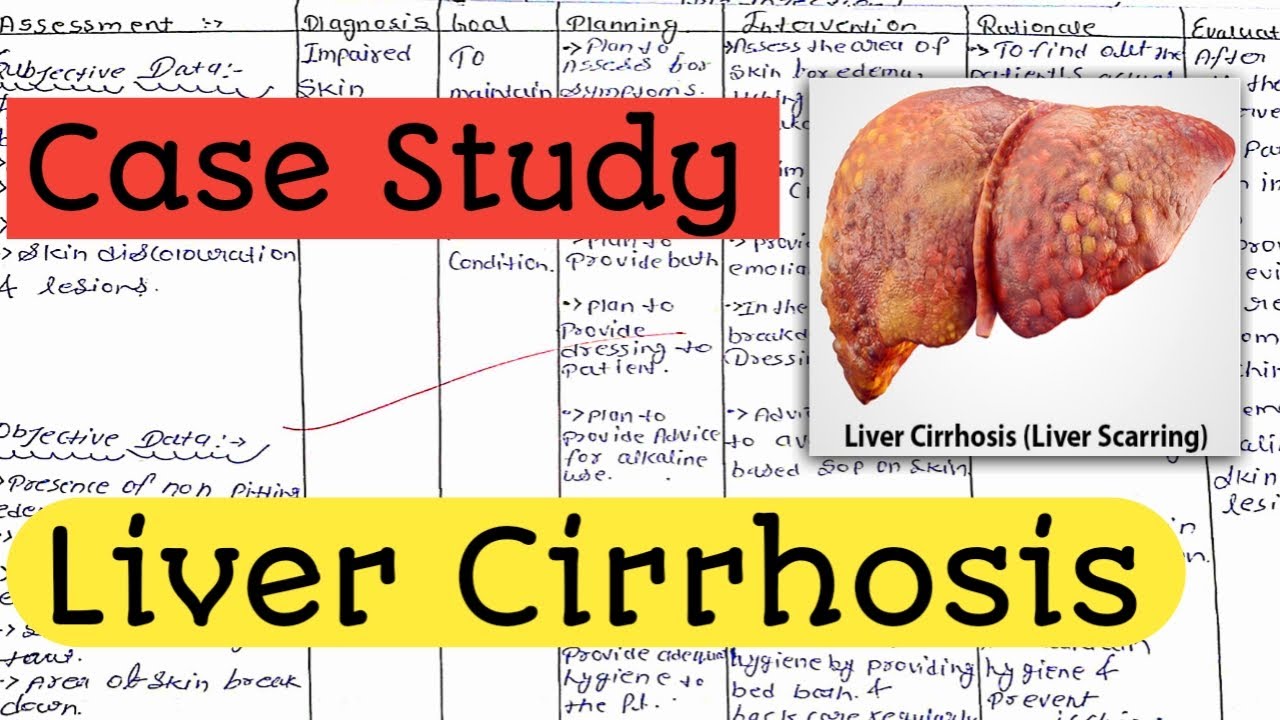 case study about liver disease