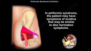 Piriformis Syndrome vs. Sciatica Pain - Vive Health