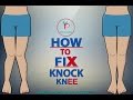 HOW TO FIX PROBLEM OF KNOCK KNEE IN HINDI -PREM MISHRA