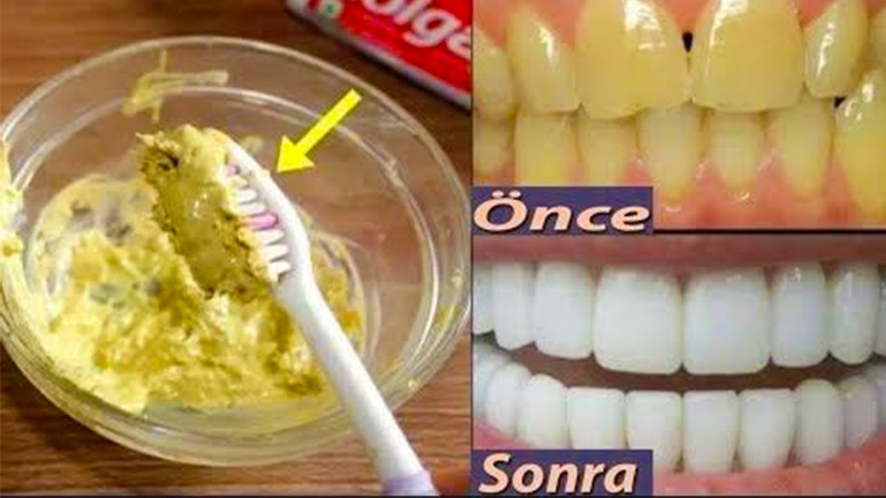 Рецепт отбеливания зубов. Отбелить зубы в домашних. Отбеливание зубов в домашних условиях. Народные методы отбеливания зубов. Зубы отбеливаются апельсином.