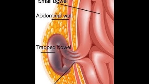 Strangulated hernia symptoms