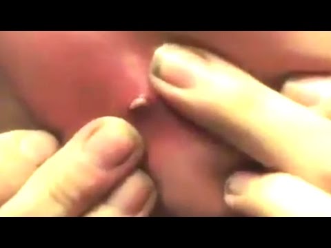 Zit Popping, Blackheads & Pimples - WGM Trailer - 동영상