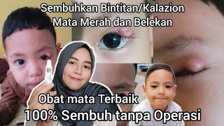 Cara Cepat Menghilangkan Kalazion, Bintitan, Belekan, Mata Merah 100% Ampuh - Pengalaman Pribadi