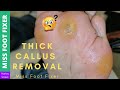 Thick Callus Removal | Crazy Big Callus  | Miss Foot Fixer