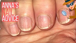 How To Care For Ridgy Nails  [ANNA'S NAIL ADVICE] ‍♀