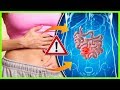 10 Síntomas Comúnes De La Diverticulosis