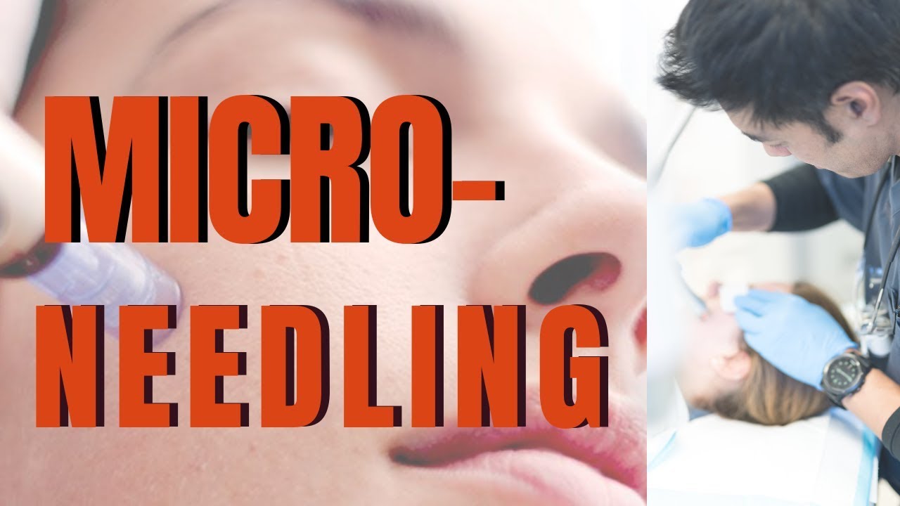 micro-needling-what-you-need-to-know-from-dermatologist-dr-davin