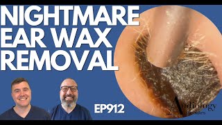 NIGHTMARE EAR WAX REMOVAL - EP912