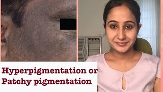 Permanently Cure DARK SPOTS ,HYPERPIGMENTATION or BLACK MARKS (HINDI) Dr.Madhuri Anantwar