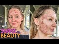 My Acne Became A 'Monster' At 20 | SHAKE MY BEAUTY