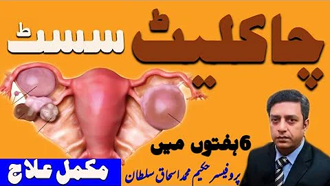 CHOCOLATE CYST' causes & treatment(     )By Prof-H...