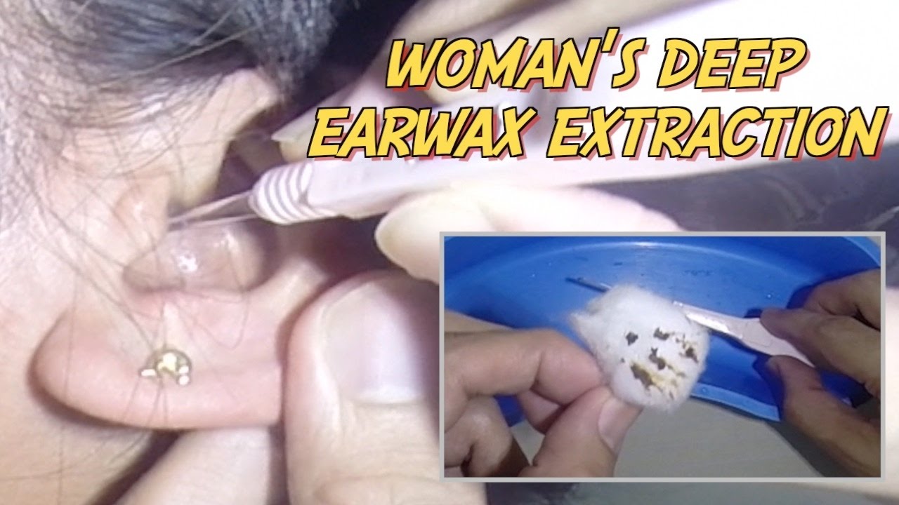 Woman's Deep Earwax Extraction YouTube