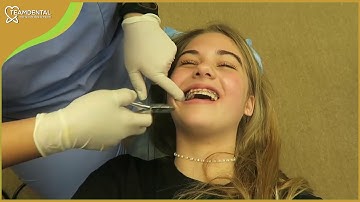 Cận cảnh quy trình tháo niềng răng tại Nha khoa TeamDental