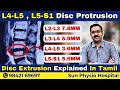 Sciatica L4-L5, L5-S1 Disc Protrusion &amp; Disc Extrusion Treatment Explained in Tamil | Sun Physio