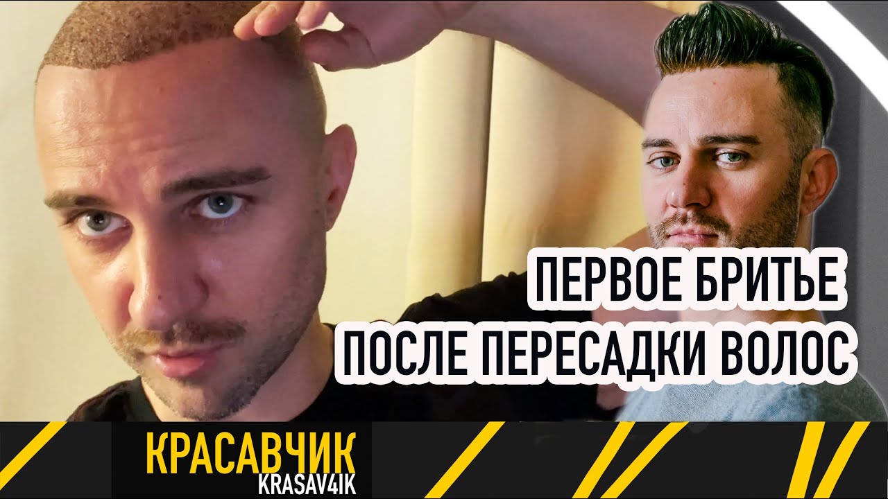 Как не нужно! Ошибка линия роста волос при пересадке волос / Красавчик ...