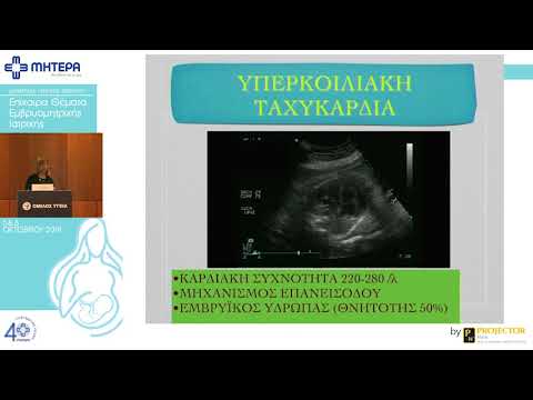 Βίντεο: 3 τρόποι παρακολούθησης του καρδιακού ρυθμού του εμβρύου