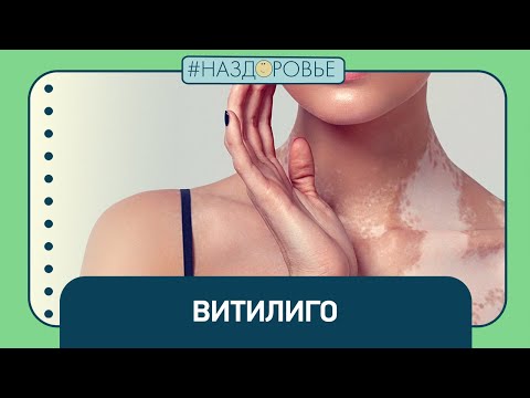 #НАЗДОРОВЬЕ: витилиго