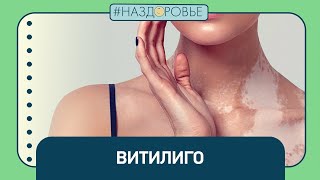 #НАЗДОРОВЬЕ: витилиго