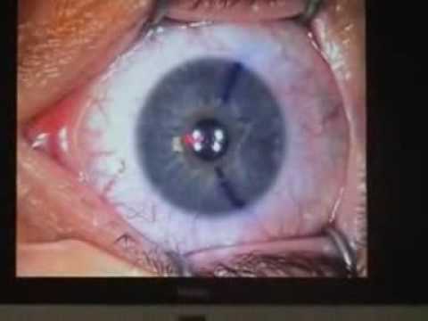 Operation myopie Dr Chemla Centre Vision Laser Paris Ouest - YouTube