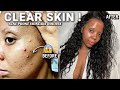 ADULT ACNE → CLEAR✨ SKINCARE ROUTINE 2023 ACNE OILY SKIN| 60 SEC DOUBLE CLEANSE Reduce 𝐓𝐄𝐗𝐔𝐑𝐄𝐃 Skin