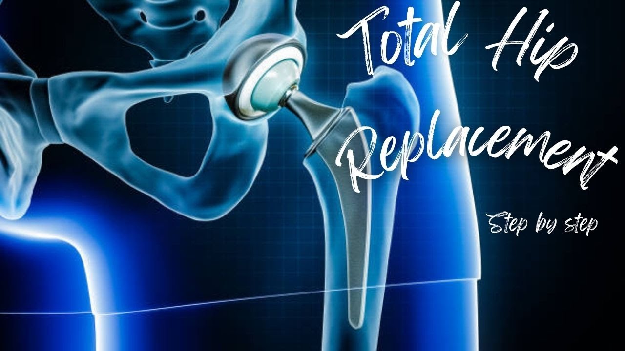 Hip Replacement 101: What you need to know 📚🔍👀 - YouTube