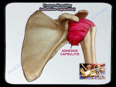 Video: Heb ik capsulitis?