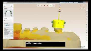 Special Implants Impression Tray Design in @3shape