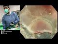 obese 垂直肌肉 splenic flexure ESD, 3.5cm