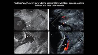 New #UOGJournal videoclip on screening for vasa previa