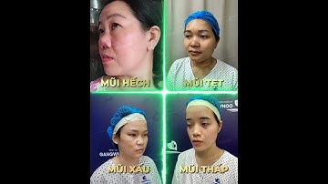 DÀNH CHO CHỊ EM MUỐN NÂNG MŨI AN TOÀN, BỀN ĐẸP - CÙNG VỚI BÁC SĨ PHÙNG MẠNH CƯỜNG