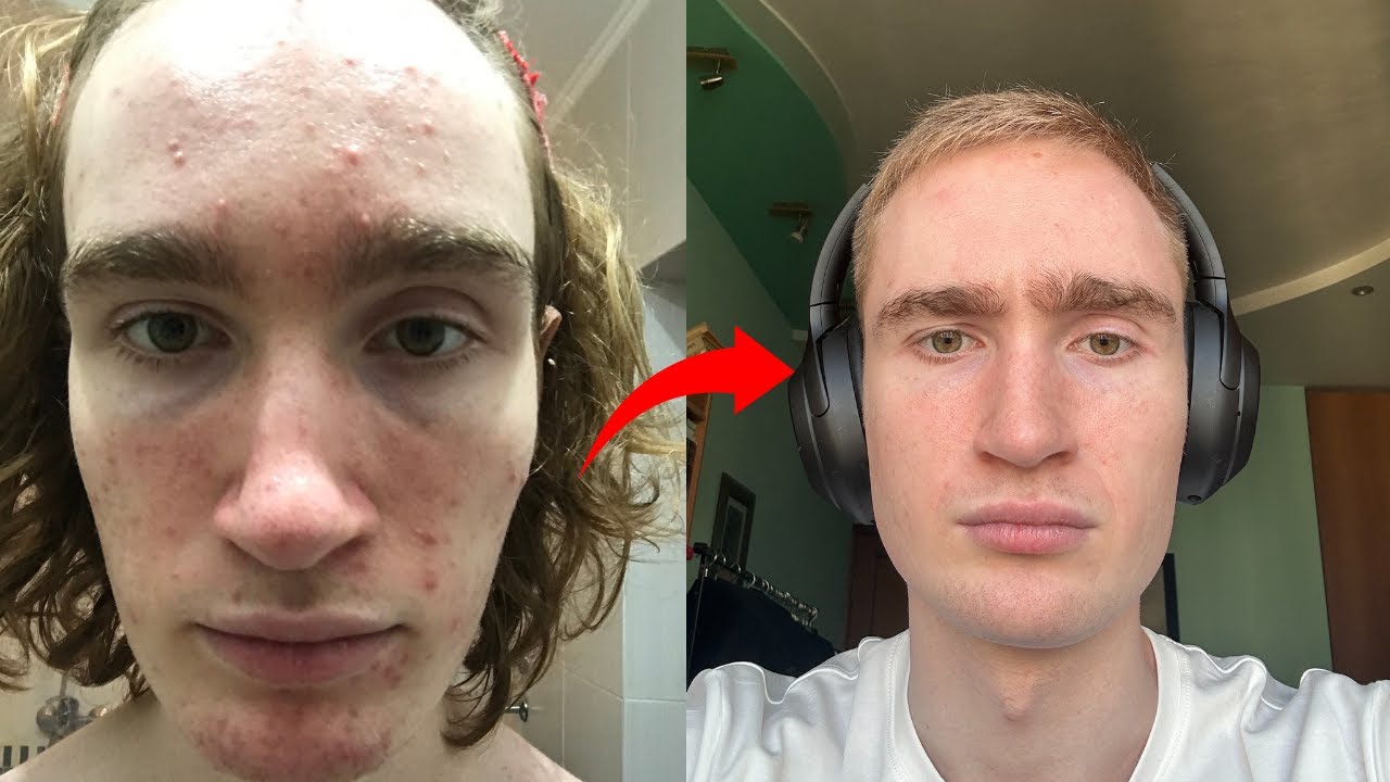 Как я полностью избавился от прыщей - YouTube