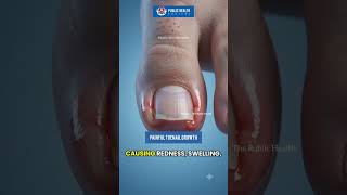 Ingrown Toenail Explained 🦶 #shorts #toenails #nails #explore #3d #science #growth #nailtech
