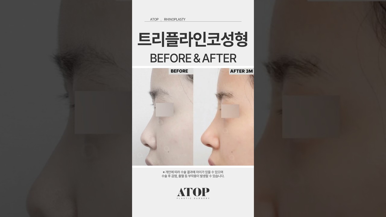 [А-ТОП Гоо Сайхны Мэс Заслын Эмнэлэг] Гурвалсан Шугамын Ринопластик_Сэтгэгдэл 1