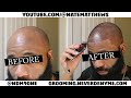 How To Get Your Hairline Back | From Bald To Edge Up | Hairline Restoration