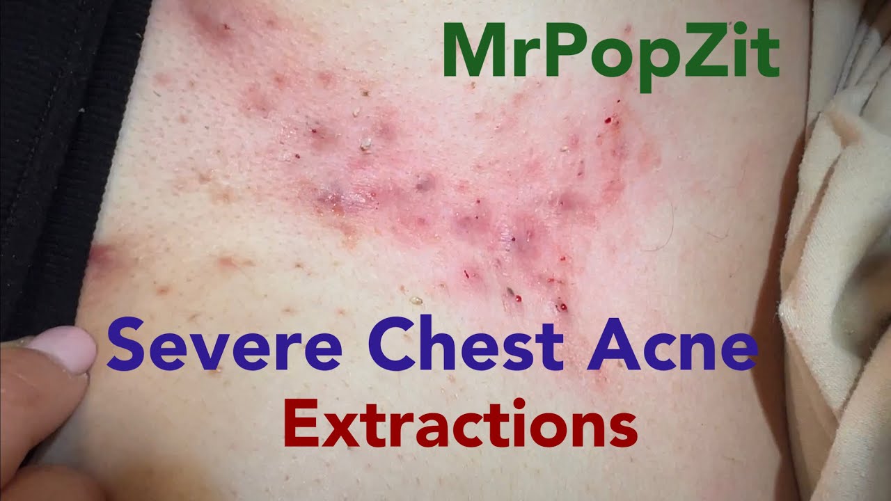 Large clogged pores emptied from chest area. Extraction techniques.Many curled ingrown hairs removed