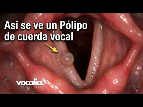 Pólipo de Cuerdas Vocales  - Vocal Fold Polyp  - Vocalia ® Laringólogos