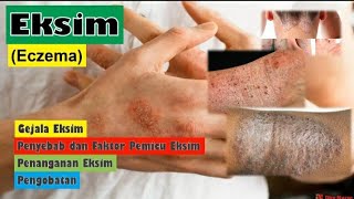 Eczema - Causes, Symptoms and Treatment of Eczema