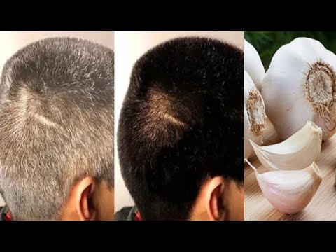 ผมหงอกก่อนวัย แก้ยังไง!! Gray Hair To Black Hair Naturally with Garlic & Olive oil Permanently