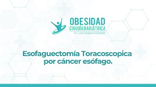 Esofaguectomía Toracoscopica por cáncer esófago.