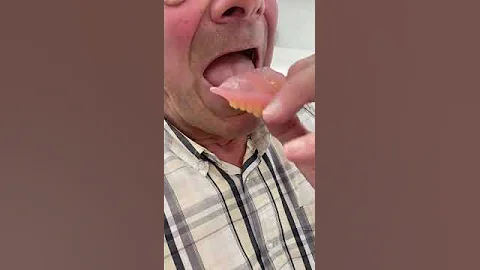 Experience the Suction Fit: Bespoke Dentures for Unmatched Stability | Vallance Dental Centre