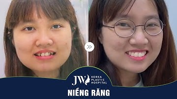 Kết quả sau 18 tháng tháo niềng răng tại nha khoa JW!