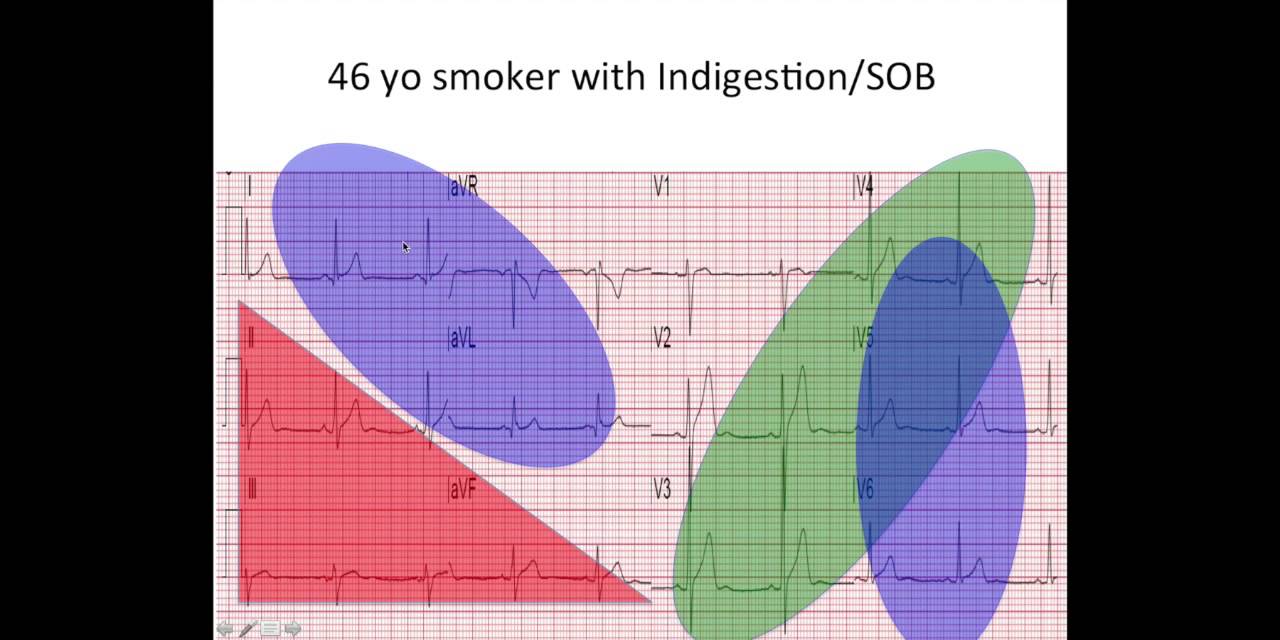 EKG Quiz    STEMI or Not