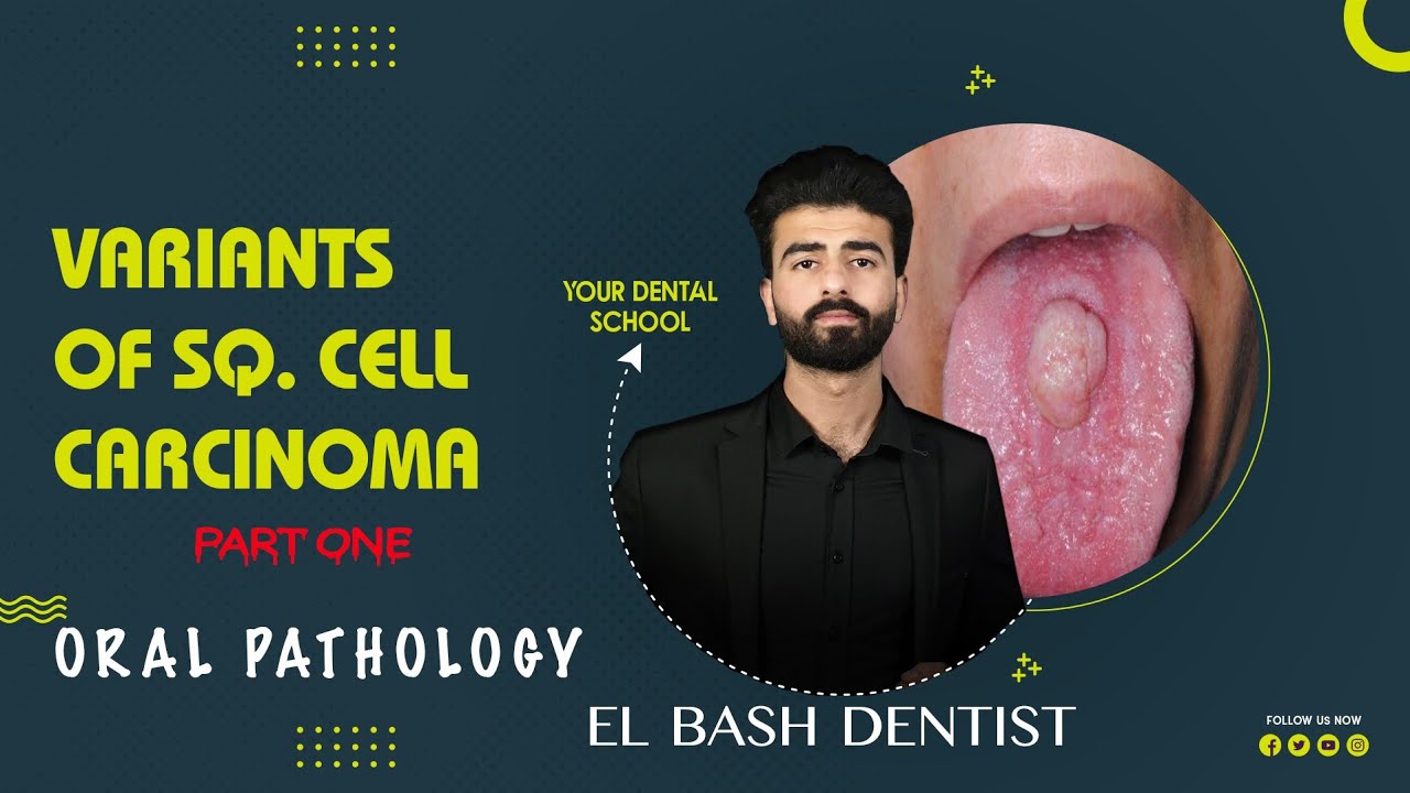 variants of squamous cell carcinoma 1 || oral pathology || عزت شومان